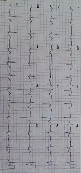 12-Lead electrocardiogram showed ST segment elevation of greater than 1 mV in lead aVR