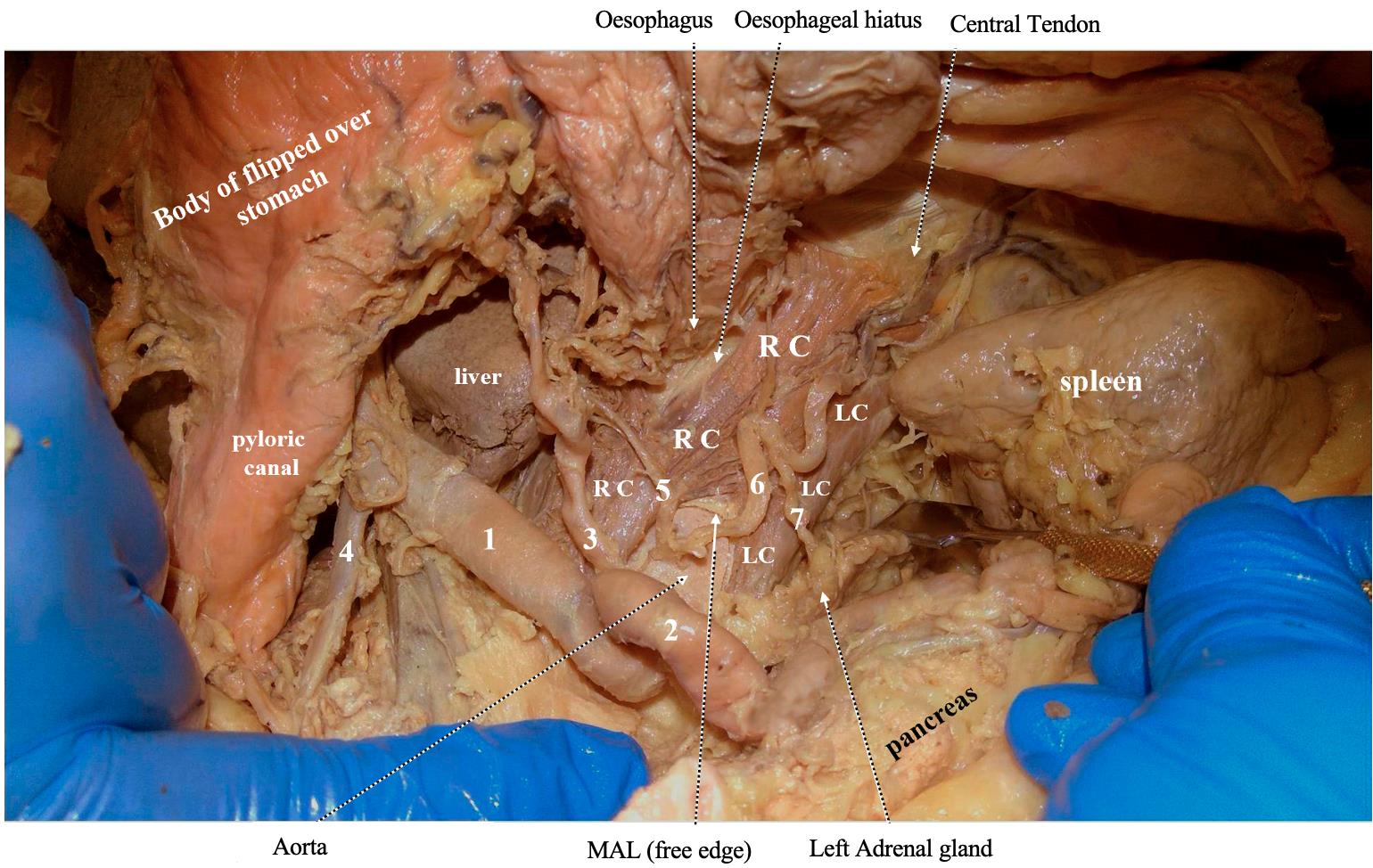 Agross image of the diaphragm's right and left crura, as well as the median arcuate ligament. RC: right crus of diaphragm, LC: left crus of diaphragm. Arteries: 1. common hepatic, 2. splenic, 3. left gastric, 4. gastrodu