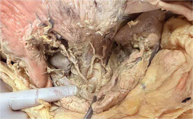 Partial exposure of the MAL and its arching edge. Normally, at the level of T12, the MAL wraps the aorta anteriorly and bilaterally, forming with the body of this vertebra the aortic hiatus. The coeliac trunk is clearly 