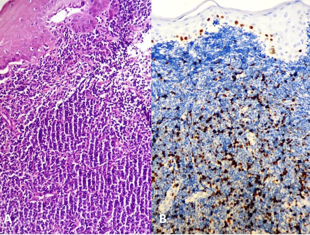A: Atypical lymphoid infiltration under tonsillar squamous epithelium, H&Estain, magnification x200.