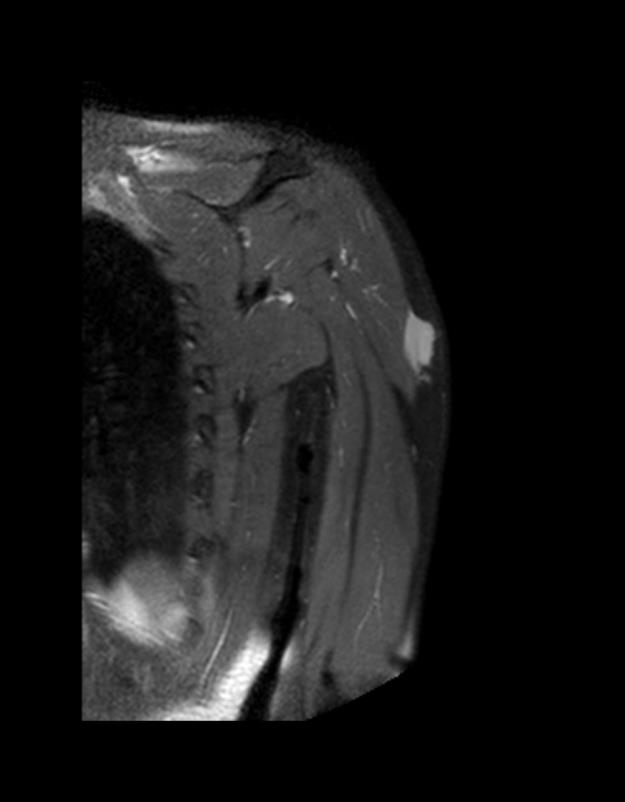 The Large Lesion - Coronal Section