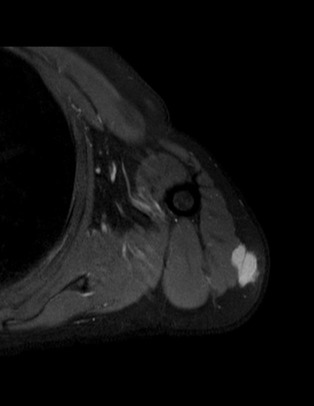The Large Lesion – Transverse Section