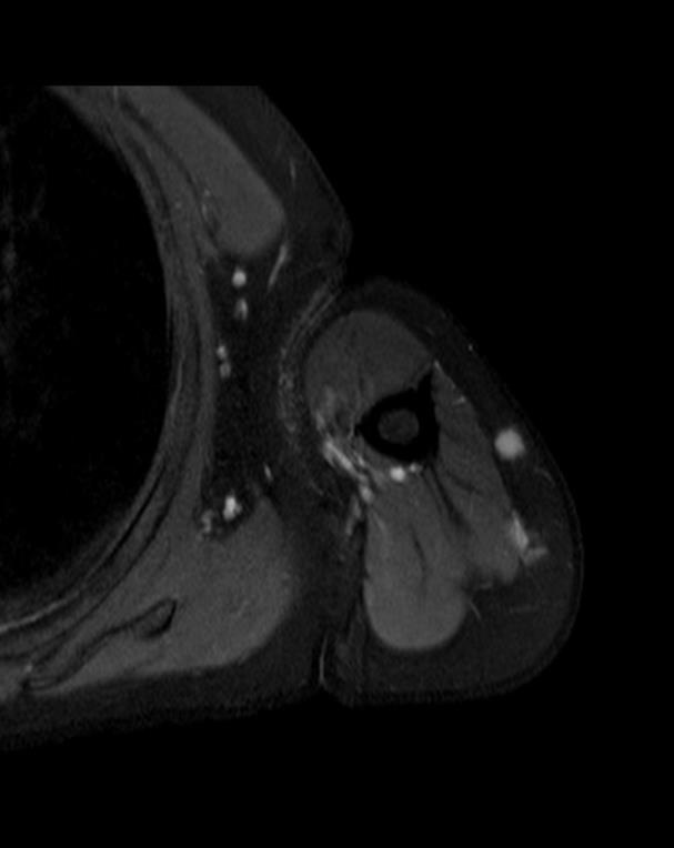 The Small Lesion – Coronal Section Figure 5. The Small Lesion – Transverse Section