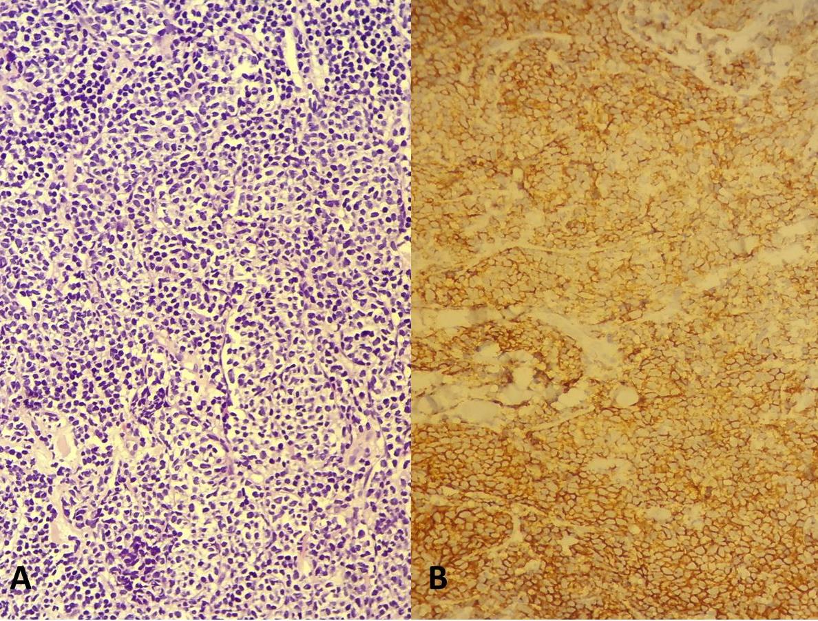 A: Atypical lymphoid infiltration in skin tru-cut biopsy sample, H&Estain, magnification x200. B: Atypical lymphoid infiltrate in skin tru-cut biopsy sample, CD20 immunohistochemistry, DAB chromogen,