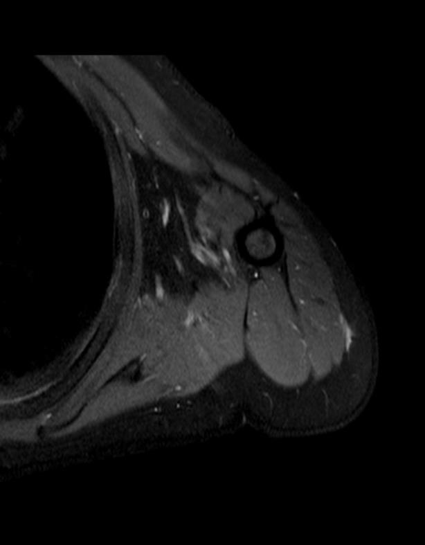 The Large Lesion After Therapy - Trans-