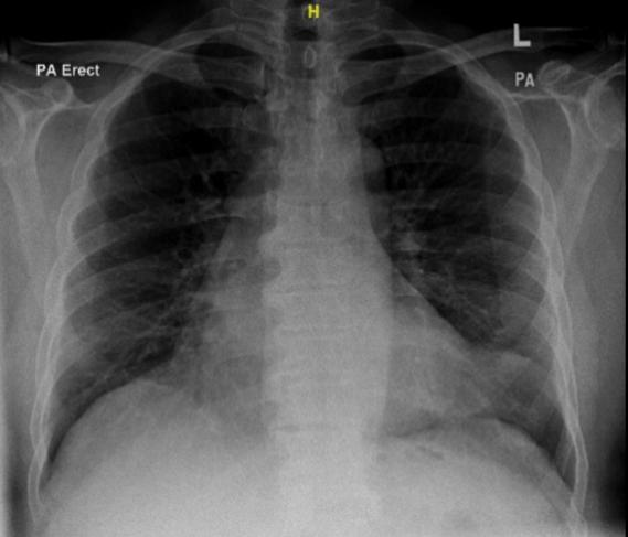 Postoperative portable X- ray of the same patient showing fea- tures consistent with pulmonary edema.