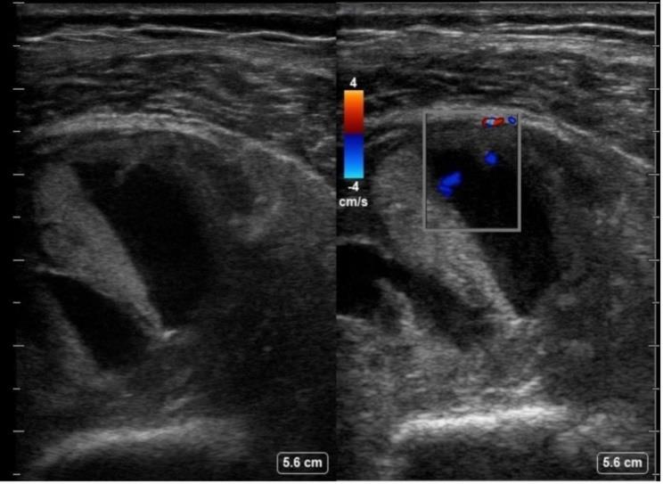Dual image: (Left)- B-mode (grayscale) ultrasound shows a well-defined hypoechoic fluid collection within the muscle, consistent with intramuscular haema- toma. (Right)- Colour Doppler image evaluates blood flow within t