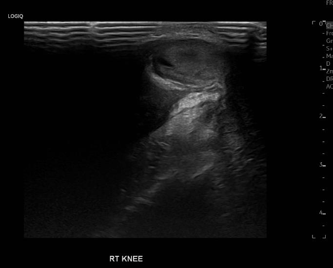 Aknee ultrasound revealed joint effusion and surrounding soft tissue