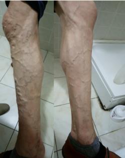 (left) shows dilated veins of the abdomen and chest, while Figure 2 depicts dilated veins of the lower extremities.