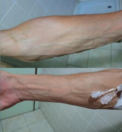 shows dilated veins of the upper extremities.