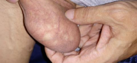 show dilated veins of the scrotum