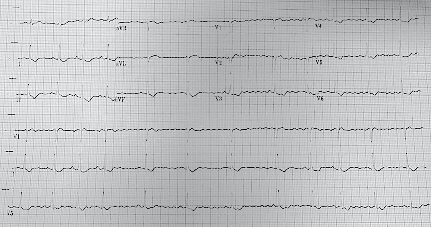 The patient’s ECG showing atrial tachycardia and digoxin effect. Note the down-sloping ST depression and the different P-wave morphologies.