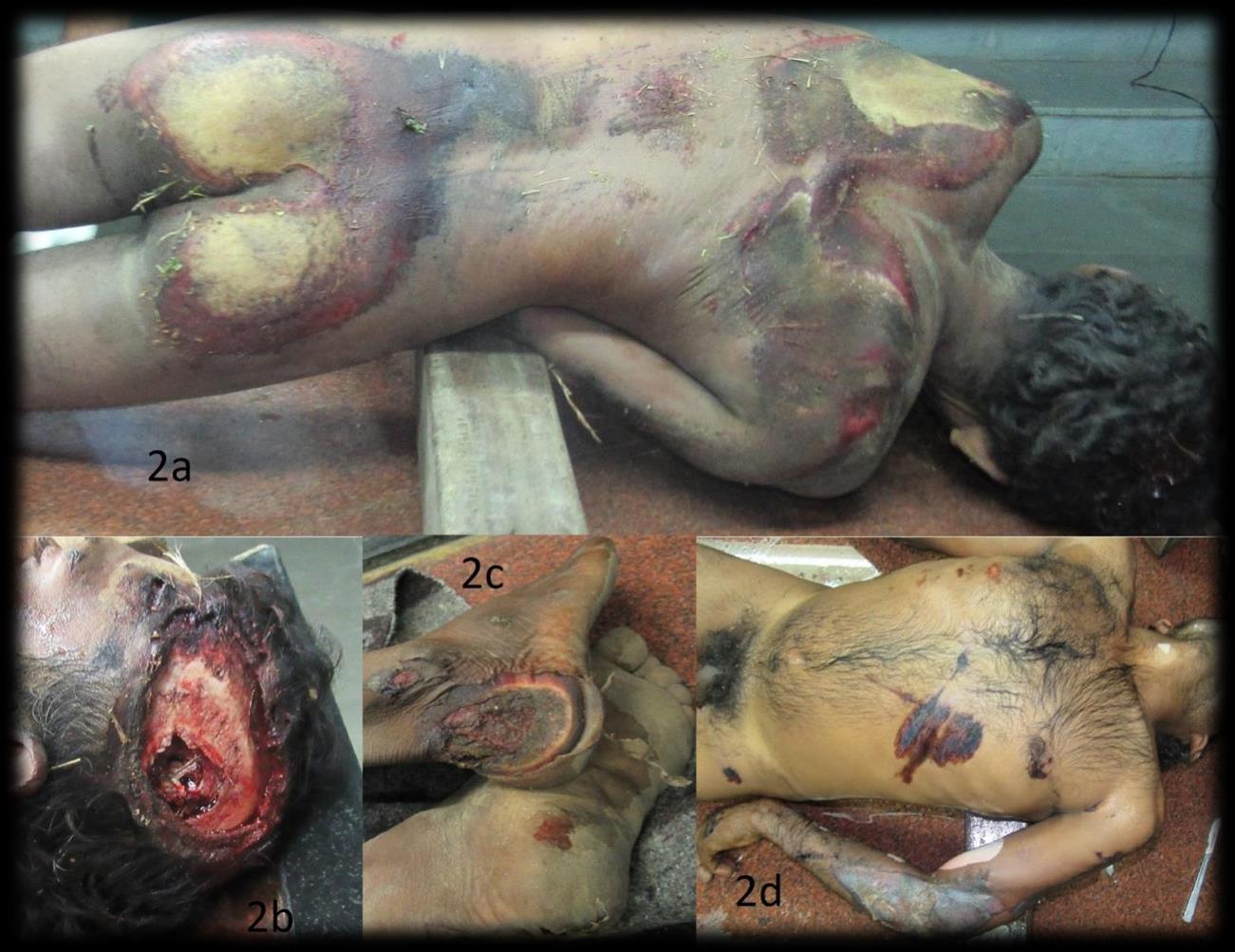 Aroad traffic accident case presented as a homicide (2a) Grazed abrasions over the prominent areas of the back (46 cm x 25 cm over the shoulder blade regions; 56 cm x 30 cm over the buttock regions). (2b) Grazing on the 
