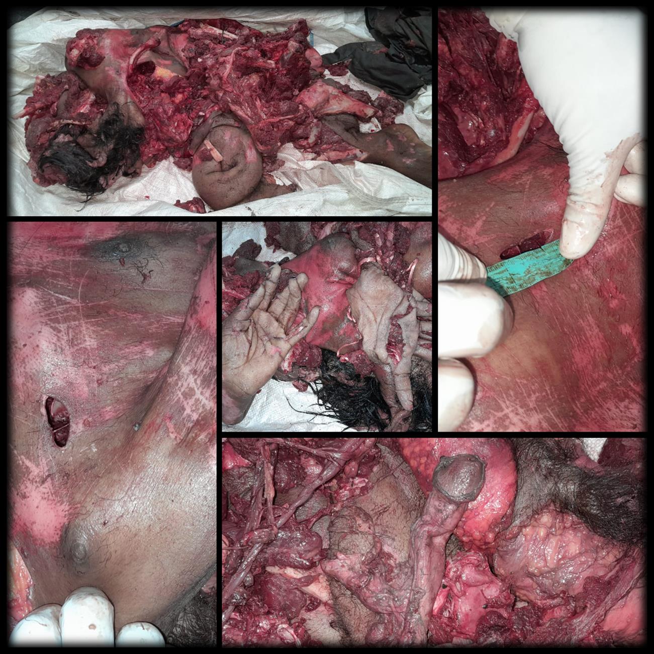 Case of homicide presented as a run-over road traffic accident Highly mutilated human remains, with identifiable parts indicating male sex. Apenetrating entry-like wound over the middle part of the chest measured 3 cm x 