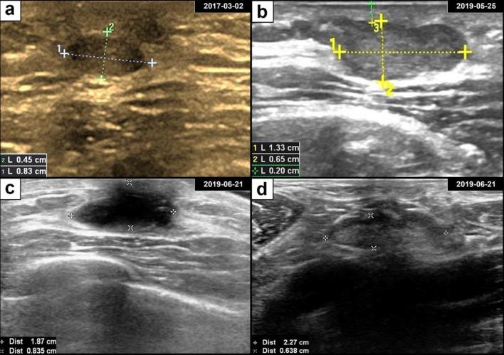 Breast adenoid cystic carcinoma ultrasound and postoperative findings. (a) Ultrasonography revealed a well-defined oval hypoechoic mass in the retroareolar region of the left breast. (b) The subareolar mass progressively