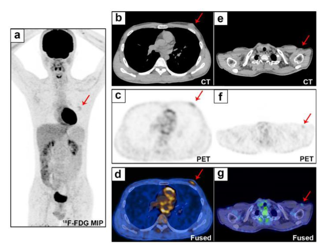 Figure 2. Whole-body evaluation by 18 F-FDG PET/CT. The 18 F-FDG PET/CT MIP (a) shows uptake (SUVmax 2.5) in the left breast lesion (b and d, red arrows), with a disordered tissue