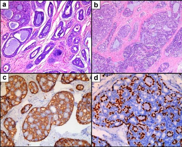 Microscopic pathology of breast adenoid cystic carcinoma. (a) H&Estaining showing a cribriform growth pattern. (b) H&Estaining showing tubular and solid growth patterns. (c) IHC staining for CD117. (d) IHC staini