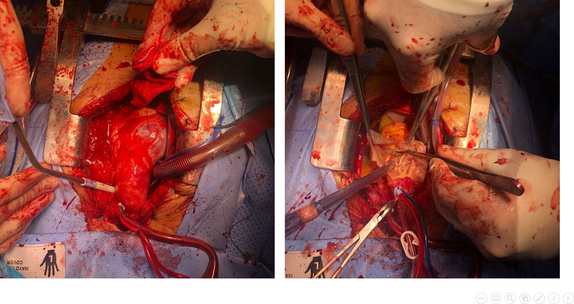 Pre-intervention aortic dissection (left), and during aortic root replacement with mechanical composite valve graft
