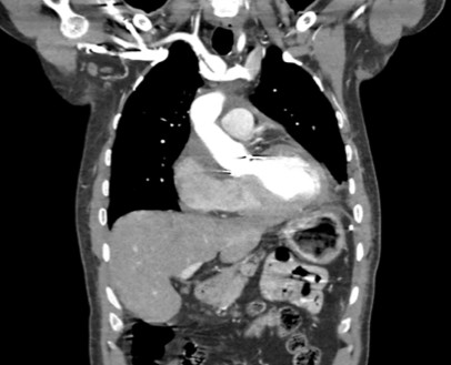 Contrast-enhanced computed tomography of chest (coronal view) did not reveal any aneurysmal dilatation or dissection. It showed postoperative changes in the mediastinum and mid-anterior chest wall with suspected post-sur