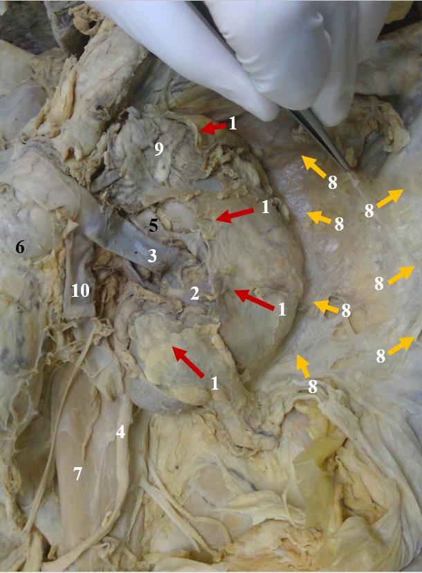 Gross image of the anterior side of the left kidney with Gerota’s fascia retracted. 1- retracted Gerota’s fascia (renal fascia), 2- left kidney, 3- left renal vein, 4- left ureter, 5- left renal artery, 6- abdominal aort