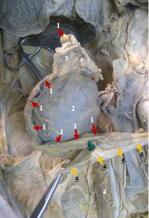 Gross image of the anterior side of the right kidney: 1- retracted Gerota’s fascia (renal fascia) boundaries, 2- right kidney, 3- right adrenal gland, 4- psoas major muscle, 5- boundaries of the areolar tissue of the per