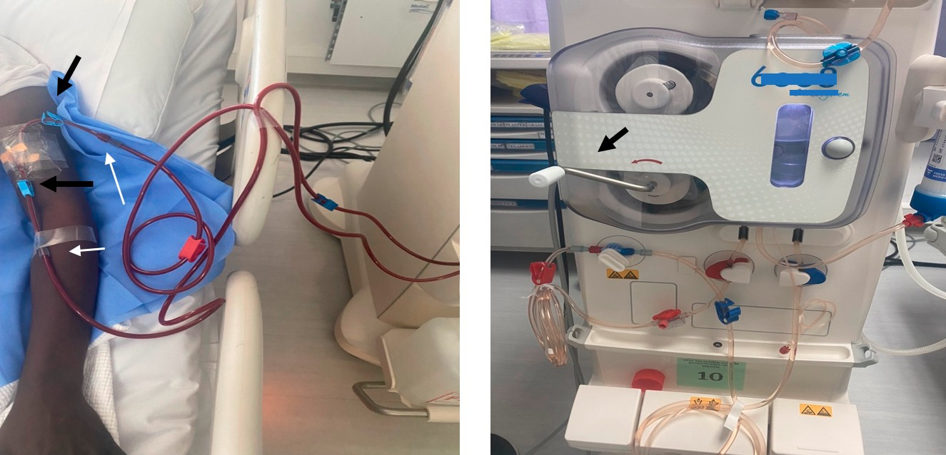 The hand crank method, whereby blood can be manually returned to the patient in the event of a power outage without backup batteries.
